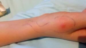 Infected Insect Bite Treatment in Bethnal Green A Complete Guide to Safe and Effective Care