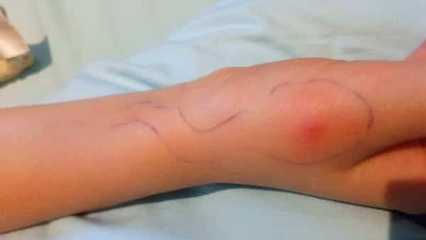 Infected Insect Bite Treatment in Bethnal Green A Complete Guide to Safe and Effective Care