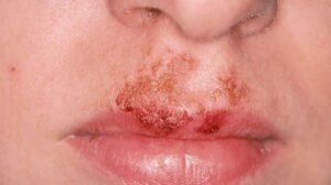 Impetigo Treatment Bethnal Green Understanding Symptoms Causes and Care
