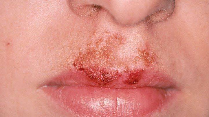 Impetigo Treatment Bethnal Green Understanding Symptoms Causes and Care