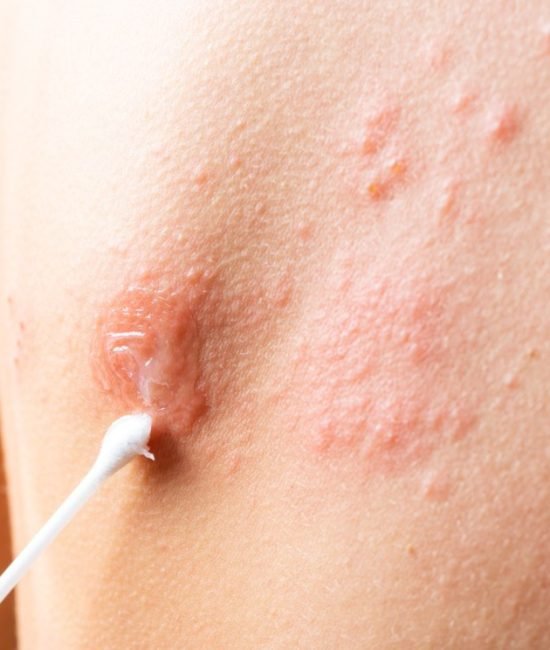 Effective-methods-for-managing-shingles