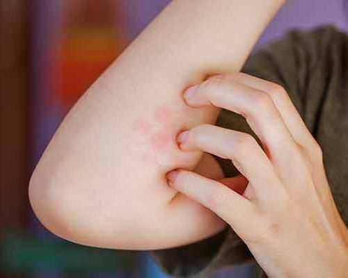 treatlocal-infected-insect-bite-service-homepage-image-600x400-1