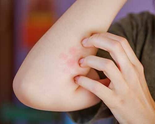 treatlocal-infected-insect-bite-service-homepage-image-600x400-1
